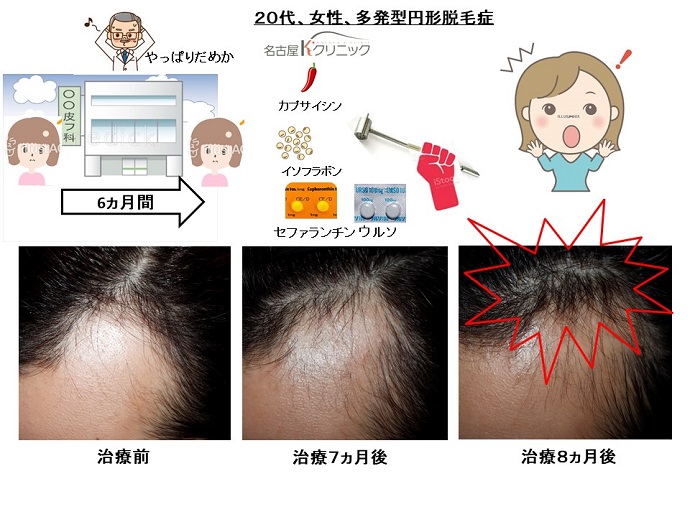 円形脱毛症　病院